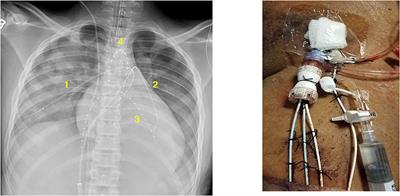 Thrombolysis in Children: A Case Report and Review of the Literature